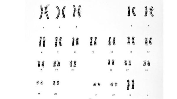 En el síndrome de Patau, el par de cromosomas 13 tiene uno más | Foto: THINKSTOCK