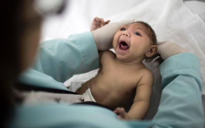 Bebé con microcefalia, afección causado por el virus Zika | Foto: AP