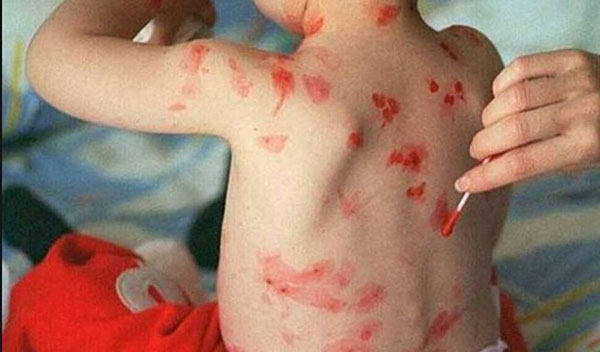 Crecen casos de varicela en el país por falta de vacunas | Foto referencial