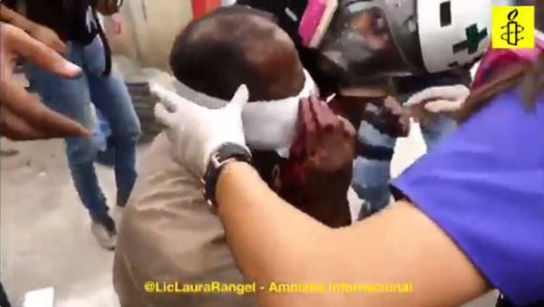 Hombre es herido con bomba lacrimógena en la cara | Captura de video 