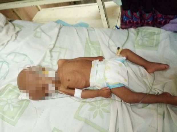 Muere niña por desnutrición en Bolívar | Foto: Correo del Caroní